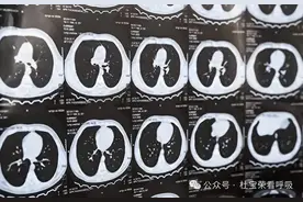 身上这2个部位疼痛，可能是肺癌发出的信号，肺结节患者要警惕！图片