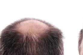 这个方法能稳住脱发，很多人却忽视了图片