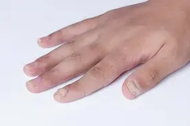 警惕！指甲上“竖纹”比较多的人，可能暗示有5个问题图片