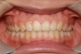 男性活多久看牙齿就知道？医生：寿命长的人，一般都有这6个特征图片