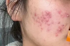 痤疮痘痘一茬接一茬？！简单教你一招，在家低成本根治不复发！图片