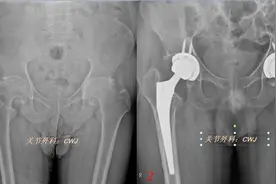 髋关节置换术后——出院后需注意的要点图片