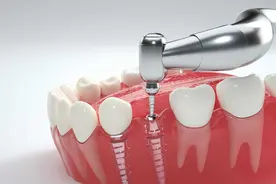 种植牙使用时间久了会松动吗？图片