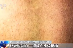 一地确诊1542例！发热、咽痛伴皮疹，无疫苗能预防！图片