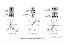 这几种心电图提示心梗危重，拒绝住院记得签字！图片