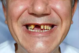 老人什么时候开始“掉牙”才正常？牙齿脱落后，需要注意哪些事？图片