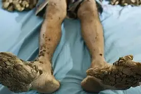 7年前“树人”刘忠文：双手长满树枝，生活无法自理，如今怎么样图片