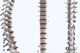 经常低头玩手机？常跷二郎腿？两个肩膀高低不同……请别忽视孩子脊柱侧弯图片