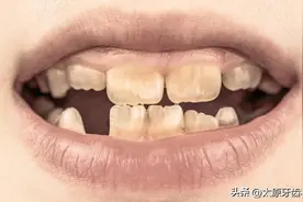 我的牙齿为什么变黑了？图片