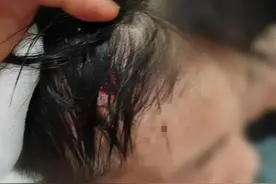 五星级酒店浴室玻璃门突然爆裂，致2男孩受伤，可能留下后遗症！图片