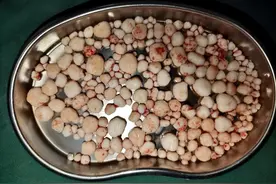 头皮发麻！近300颗！福建一女子体内取出……医生：震惊图片