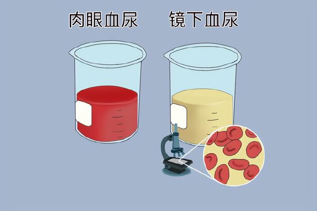 医生提醒：出现这种尿，可能有肿瘤！这些预警信号，别忽视了