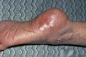 好可怕!“三个月的宝宝因真菌感染没救过来”原来臭脚丫真的有毒图片