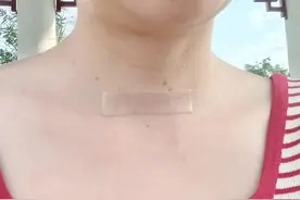 甲状腺癌术后不办门特亏大了，国家福利赶紧去办，门诊费用能报销图片