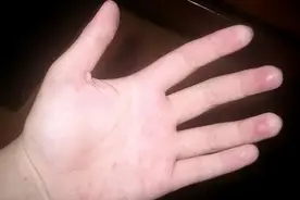 手心脚心发热要分6种情况，看看你是哪一种？中医6招轻松搞定图片