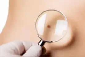 脖子和腋下的“小肉粒”是什么？皮肤上各种不明原因“痦子”，要警惕了图片