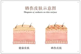 【健康科普】晒后皮肤的“复活术”——修复秘籍大公开图片