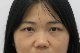 从小就被嘲笑是猪鼻子，35岁姑娘鼓起勇气隆鼻，术后宛如“新生”图片