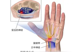 睡觉手麻要小心，这3种原因经常被忽略！图片