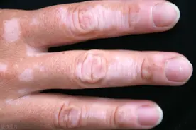 白癜风有哪些适宜的食物?图片