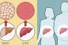 “长胖”的肝脏危害可不小！3招甩掉脂肪肝图片