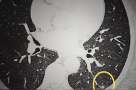肺上有一个1厘米小结节，需要穿刺活检吗？图片
