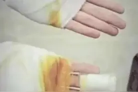 普宁一中学多名学生午后出操时手被地面烫伤，教育局：时间安排确有不妥图片