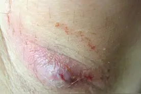 疤痕里面有硬块怎么办？什么原因导致？图片