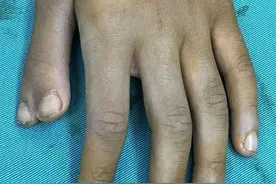 雅安仁康医院成功为拇指多指畸形男童巧施“减指整形”手术图片