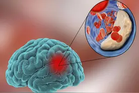 80%的脑梗患者最后不是死于脑梗，而是死在这5种全身并发症上！图片