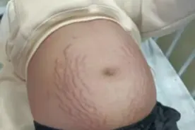 13岁女生肚子隆起爬满“妊娠纹”，照完CT妈妈当场吓懵图片