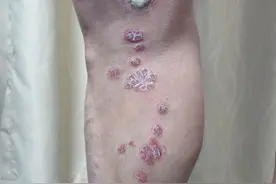 牛皮癣有它就够了，1个来月散的，干干净净图片