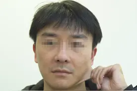 33岁金融男主播上镜显老，咬牙做了大拉皮手术，真实记录！图片
