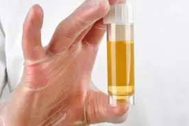 干货！带你看懂肾病检查10个关键化验指标图片