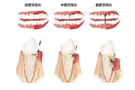 30岁重度牙周炎，还能治好吗？图片