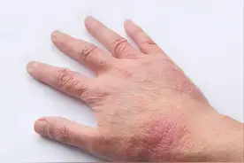 湿疹不会无缘无故复发！医生：容易湿疹复发的人，或是5事做错了图片