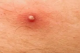 身上长出火疖子，到底是什么？皮肤专家为你辩证解答！图片