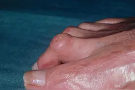 跖疣和鸡眼，你能分清吗？图片