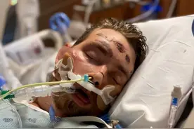 仅因为多长了一根体毛，外国小哥感染败血症，差点脑死亡图片