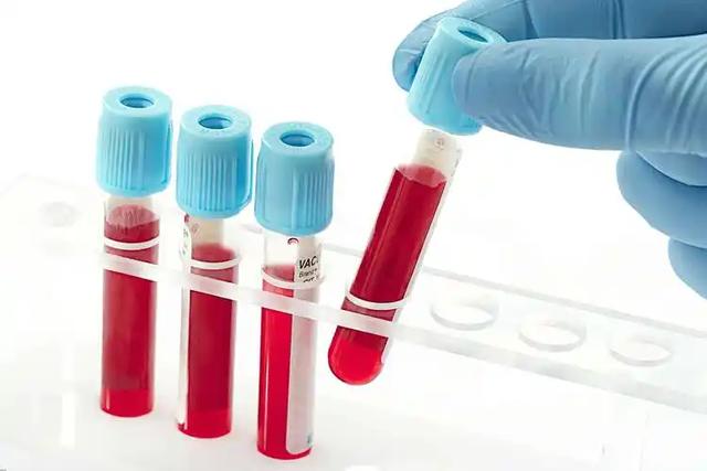 检查后发现转氨酶升高,怎么办?3种方法教你快速降低转氨酶!