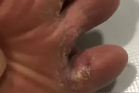 关于脚趾头烂，起泡，痒，糜烂性脚气，脚气湿气，痒且脱皮溃烂图片