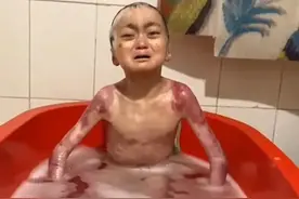 蝴蝶宝贝，与“世界上最痛苦的疾病”共处一生图片