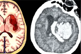 脑出血手术后昏迷促醒，家属做好这些事情很关键图片