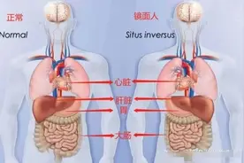 发病率百万分之一！济南章丘83岁“镜面人”在当地成功手术图片