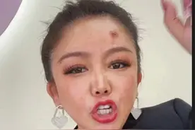 “苹果姐姐”整容失败。皮肤溃烂，言语粗鄙，老公嫌弃。后悔死了图片