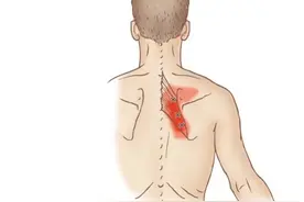 为何肩胛骨缝区域疼痛不适？该如何治疗改善？一文详细告知您图片