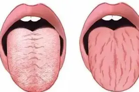 舌头有裂纹，病多在脾胃！送你4个中成药，强健脾胃，百病消图片
