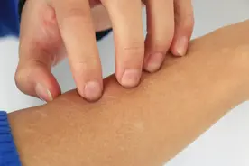 皮肤出现红斑，瘙痒难受？花1分钟，教你辨别是湿疹还是荨麻疹！图片