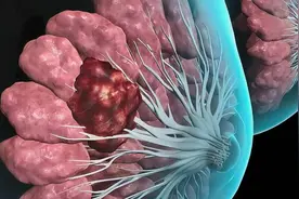 乳腺癌10年后仍会复发？不是5年后就没事了吗？图片