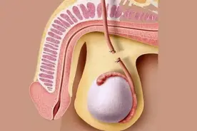 关于男性结扎，你想知道的都在这图片